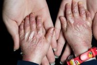 آمریکا در پرونده “تحریم کودکان پروانه‌ای” محکوم شد